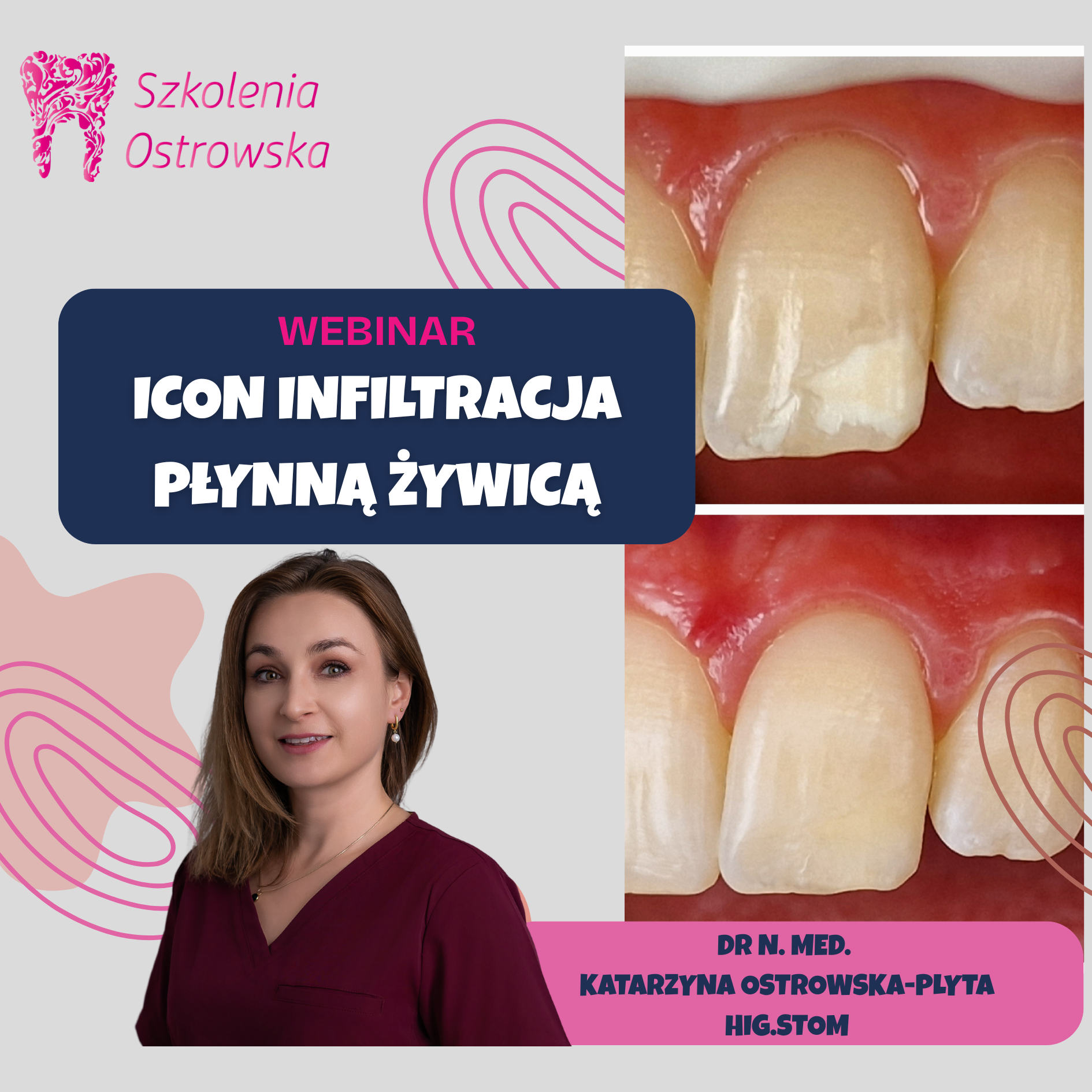 ICON – infiltracja płynną żywicą. Webinar praktyczny - obrazek 2